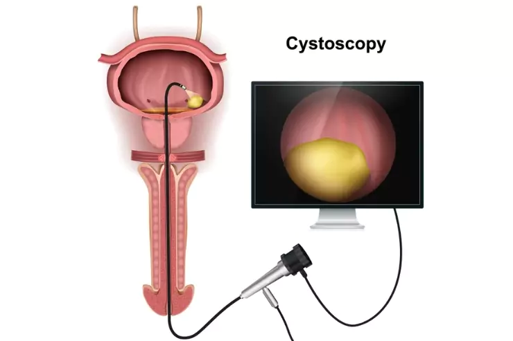 Cystoscopic Bladder Stone Removal