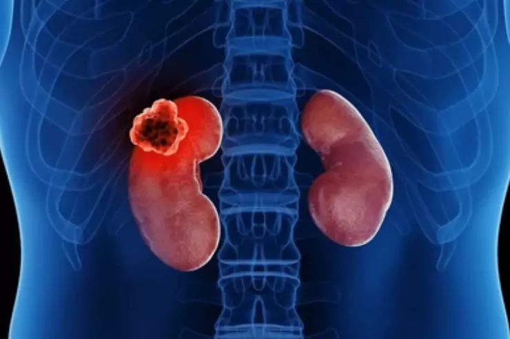 Kidney Cancer Surgery