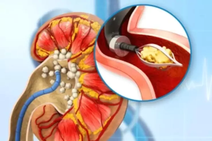 Laparoscopic Nephrectomy (Kidney Removal)