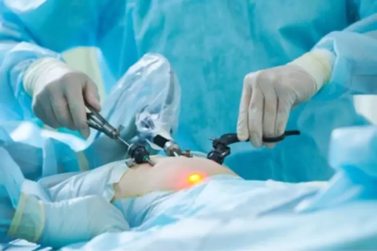 Laparoscopic Pyeloplasty (For PUJ Obstruction)