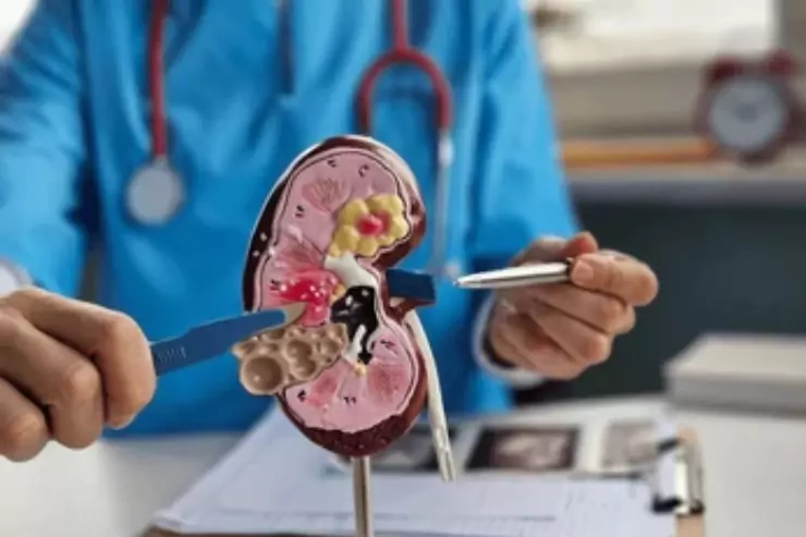 PCNL – Percutaneous Nephrolithotomy