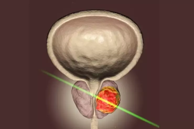 THULEP (Thulium Laser Enucleation of Prostate)