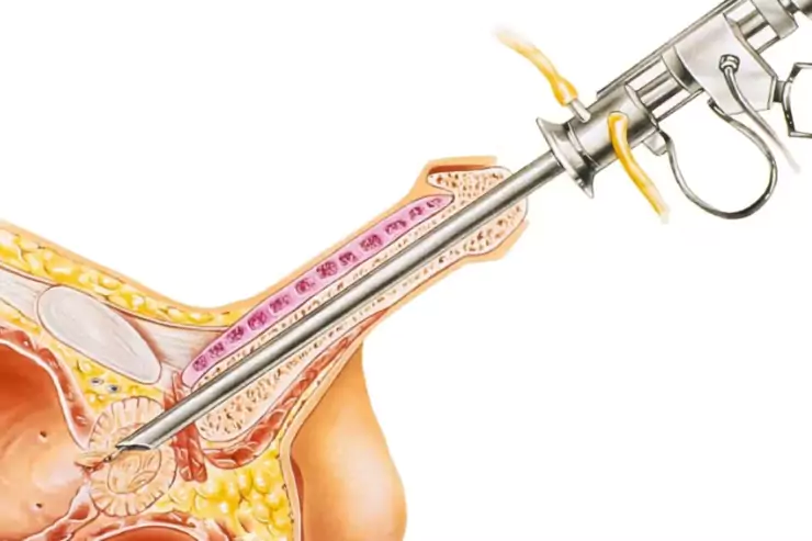 TURP (Transurethral Resection of Prostate)