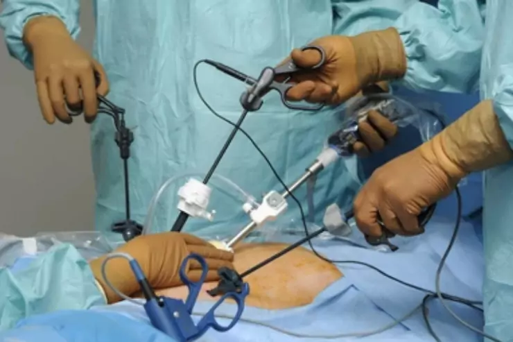 Urethral Stricture Surgeries