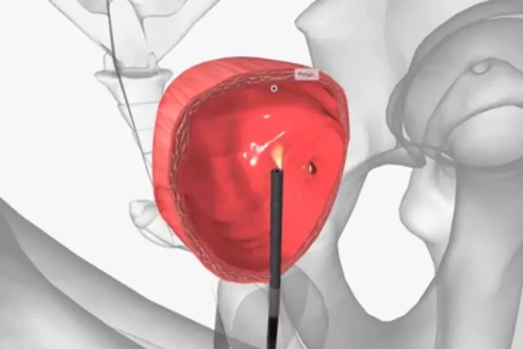 Urethroplasty & Endoscopic Repairs